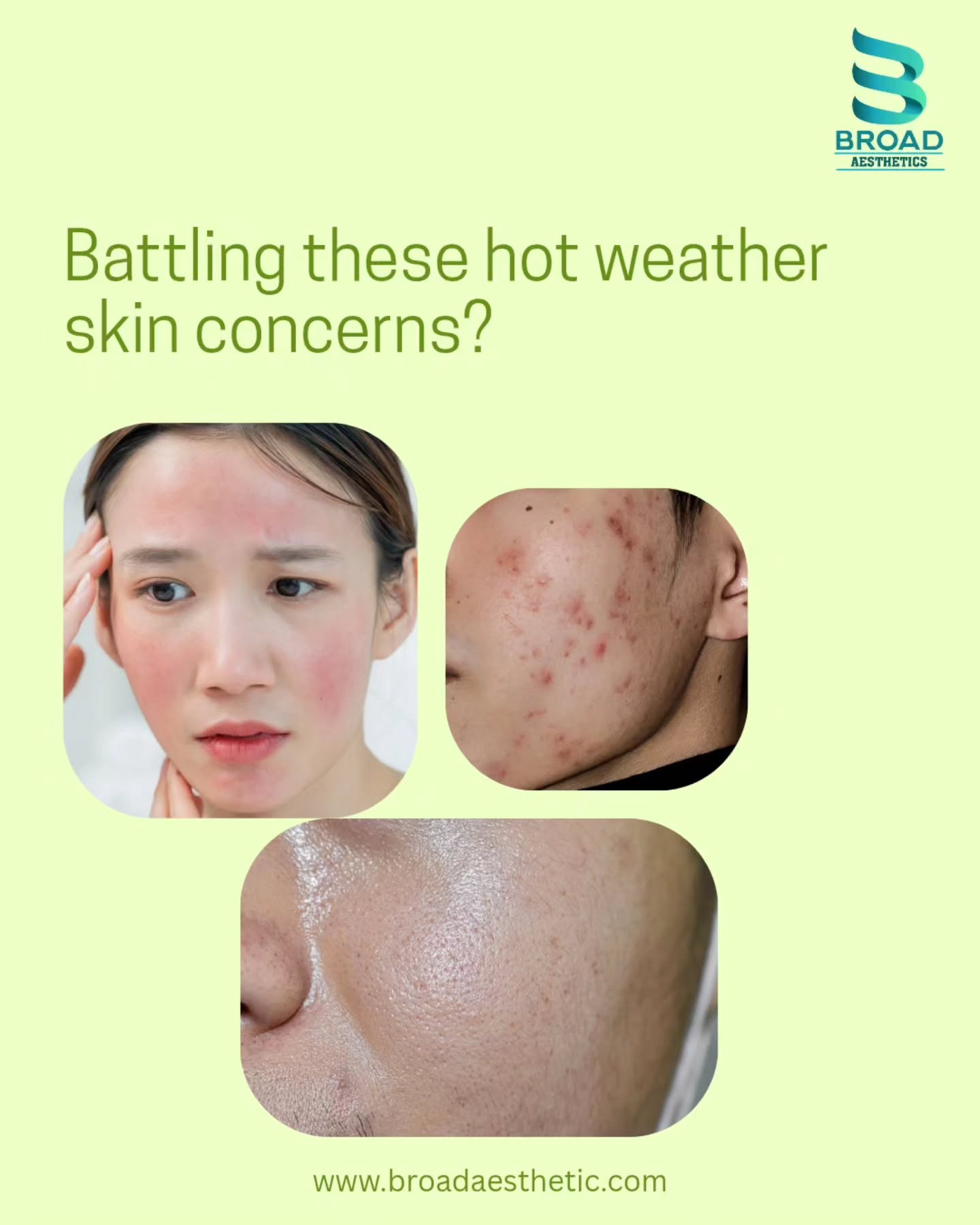 Get Rid of acne and oily skin this summer 🌞Shop your product now atwww.broadaesthetic.com#acnefree #summer #facewash #fyp #explorepage